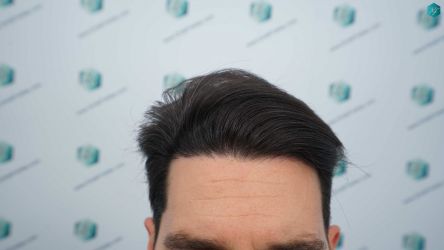 Injerto Capilar Técnica FUE Grafts 3161 (8204 Pelos) 23 25 RESULTADOS A LOS 12 MESES