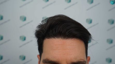 Injerto Capilar Técnica FUE Grafts 3161 (8204 Pelos) 25 25AB RESULTADOS A LOS 12 MESES