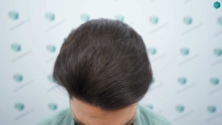 Injerto Capilar Técnica FUE Grafts 3161 (8204 Pelos) 26 25ABCD RESULTADOS A LOS 12 MESES