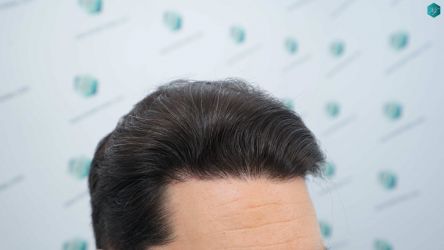 Injerto Capilar Técnica FUE Grafts 3161 (8204 Pelos) 28 26 RESULTADOS A LOS 12 MESES