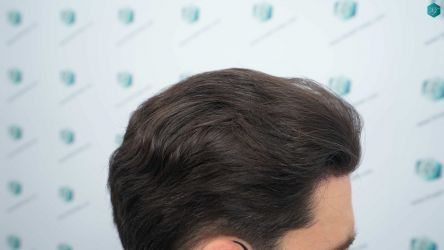 Injerto Capilar Técnica FUE Grafts 3161 (8204 Pelos) 29 27A RESULTADOS A LOS 12 MESES