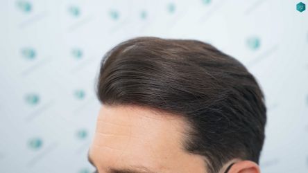 Injerto Capilar Técnica FUE Grafts 3161 (8204 Pelos) 31 28 RESULTADOS A LOS 12 MESES
