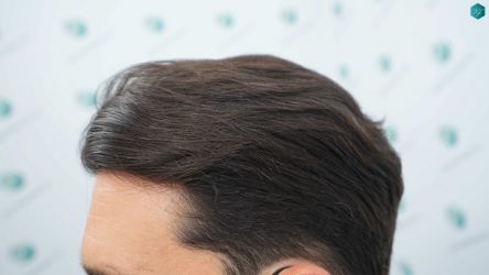 Injerto Capilar Técnica FUE Grafts 3161 (8204 Pelos) 30 29 RESULTADOS A LOS 12 MESES