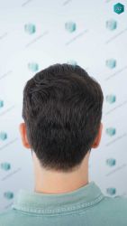 Injerto Capilar Técnica FUE Grafts 3161 (8204 Pelos) 34 30 RESULTADOS A LOS 12 MESES