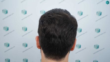 Injerto Capilar Técnica FUE Grafts 3161 (8204 Pelos) 33 30a RESULTADOS A LOS 12 MESES