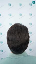 Injerto Capilar Técnica FUE Grafts 3161 (8204 Pelos) 54 31 RESULTADOS A LOS 12 MESES