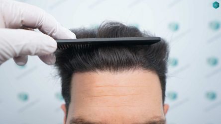 Injerto Capilar Técnica FUE Grafts 3161 (8204 Pelos) 35 32 RESULTADOS A LOS 12 MESES