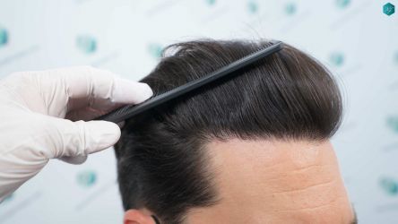 Injerto Capilar Técnica FUE Grafts 3161 (8204 Pelos) 37 33 RESULTADOS A LOS 12 MESES
