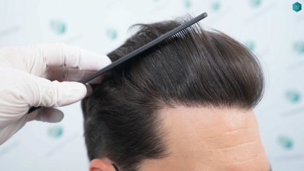 Injerto Capilar Técnica FUE Grafts 3161 (8204 Pelos) 38 34 RESULTADOS A LOS 12 MESES