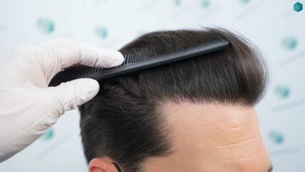 Injerto Capilar Técnica FUE Grafts 3161 (8204 Pelos) 36 34AB RESULTADOS A LOS 12 MESES