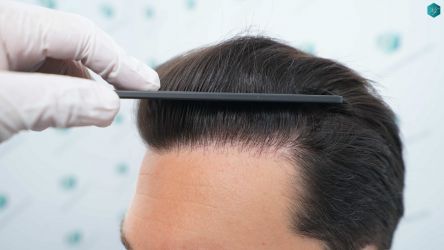 Injerto Capilar Técnica FUE Grafts 3161 (8204 Pelos) 39 35 RESULTADOS A LOS 12 MESES