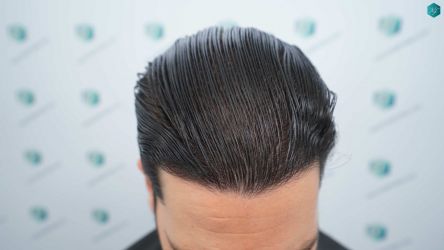 Injerto Capilar Técnica FUE Grafts 3161 (8204 Pelos) 44 45AA RESULTADOS A LOS 12 MESES