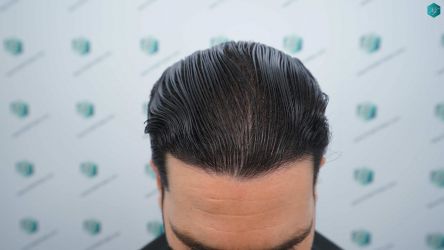 Injerto Capilar Técnica FUE Grafts 3161 (8204 Pelos) 46 45AB RESULTADOS A LOS 12 MESES
