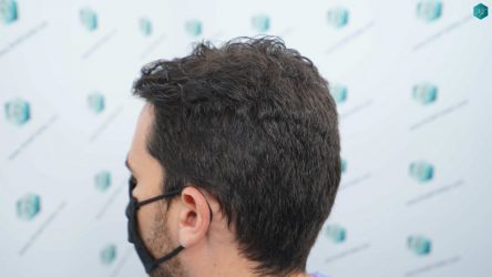 Injerto Capilar Técnica FUE Grafts 3161 (8204 Pelos) 2 5 ANTES DEL TRASPLANTE DE PELO