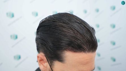 Injerto Capilar Técnica FUE Grafts 3161 (8204 Pelos) 47 50 RESULTADOS A LOS 12 MESES