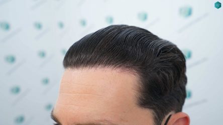 Injerto Capilar Técnica FUE Grafts 3161 (8204 Pelos) 50 52 RESULTADOS A LOS 12 MESES