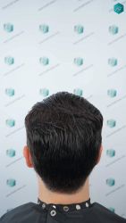 Injerto Capilar Técnica FUE Grafts 3161 (8204 Pelos) 53 55 RESULTADOS A LOS 12 MESES