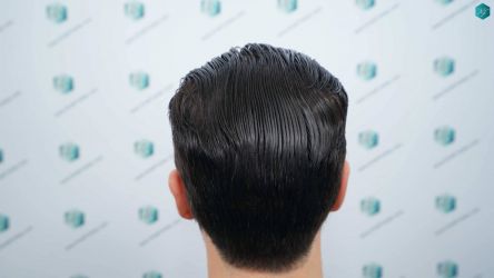 Injerto Capilar Técnica FUE Grafts 3161 (8204 Pelos) 52 56 RESULTADOS A LOS 12 MESES