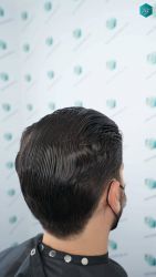Injerto Capilar Técnica FUE Grafts 3161 (8204 Pelos) 48 57 RESULTADOS A LOS 12 MESES
