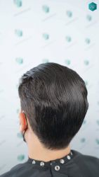 Injerto Capilar Técnica FUE Grafts 3161 (8204 Pelos) 32 58 RESULTADOS A LOS 12 MESES
