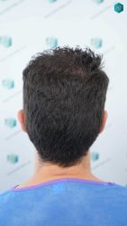 Injerto Capilar Técnica FUE Grafts 3161 (8204 Pelos) 3 6 ANTES DEL TRASPLANTE DE PELO