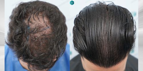 Injerto Capilar Técnica FUE Grafts 3161 (8204 Pelos) 57 60 COMPARATIVAS copia