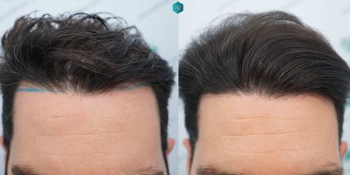 Injerto Capilar Técnica FUE Grafts 3161 (8204 Pelos) 55 61 COMPARATIVAS