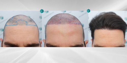 Injerto Capilar Técnica FUE Grafts 3161 (8204 Pelos) 58 62 COMPARATIVAS