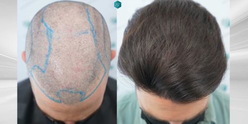 Injerto Capilar Técnica FUE Grafts 3161 (8204 Pelos) 56 63 COMPARATIVAS