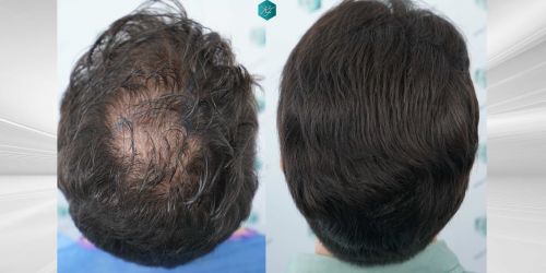 Injerto Capilar Técnica FUE Grafts 3161 (8204 Pelos) 59 64 COMPARATIVAS
