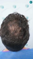 Injerto Capilar Técnica FUE Grafts 3161 (8204 Pelos) 4 7 ANTES DEL TRASPLANTE DE PELO