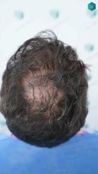Injerto Capilar Técnica FUE Grafts 3161 (8204 Pelos) 5 8 ANTES DEL TRASPLANTE DE PELO