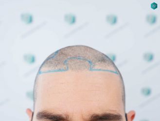 DISEÑO LÍNEA DE INJERTO 9 ANTES DEL TRASPLANTE DE PELO