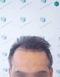 Injerto Capilar Técnica FUE Grafts 5326 (13645 Pelos) 8 10 DISENO DE LA LINEA DEL TRASPLANTE DE PELO