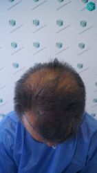 Injerto Capilar Técnica FUE Grafts 5326 (13645 Pelos) 9 10A DISENO DE LA LINEA DEL TRASPLANTE DE PELO