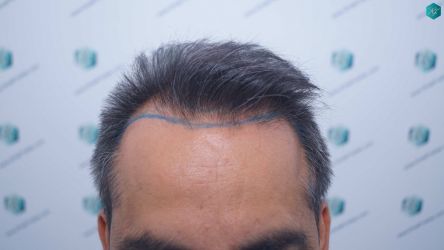 Injerto Capilar Técnica FUE Grafts 5326 (13645 Pelos) 10 11 DISENO DE LA LINEA DEL TRASPLANTE DE PELO