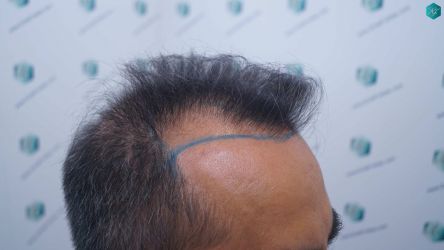 Injerto Capilar Técnica FUE Grafts 5326 (13645 Pelos) 11 12 DISENO DE LA LINEA DEL TRASPLANTE DE PELO