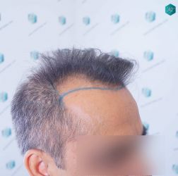 Injerto Capilar Técnica FUE Grafts 5326 (13645 Pelos) 12 13 DISENO DE LA LINEA DEL TRASPLANTE DE PELO