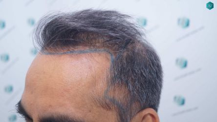 Injerto Capilar Técnica FUE Grafts 5326 (13645 Pelos) 13 14 DISENO DE LA LINEA DEL TRASPLANTE DE PELO