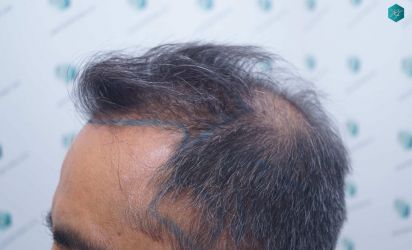 Injerto Capilar Técnica FUE Grafts 5326 (13645 Pelos) 14 15 DISENO DE LA LINEA DEL TRASPLANTE DE PELO