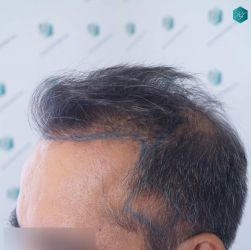 Injerto Capilar Técnica FUE Grafts 5326 (13645 Pelos) 15 16 DISENO DE LA LINEA DEL TRASPLANTE DE PELO