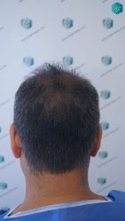 Injerto Capilar Técnica FUE Grafts 5326 (13645 Pelos) 16 17 DISENO DE LA LINEA DEL TRASPLANTE DE PELO