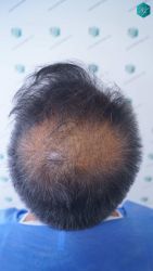 Injerto Capilar Técnica FUE Grafts 5326 (13645 Pelos) 6 18 DISENO DE LA LINEA DEL TRASPLANTE DE PELO