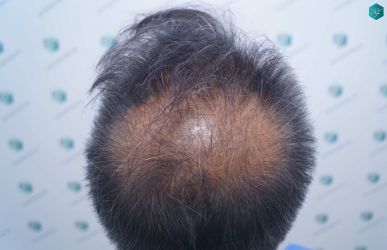 Injerto Capilar Técnica FUE Grafts 5326 (13645 Pelos) 7 19 DISENO DE LA LINEA DEL TRASPLANTE DE PELO