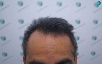 Injerto Capilar Técnica FUE Grafts 5326 (13645 Pelos) 1 2 ANTES DEL TRASPLANTE CAPILAR