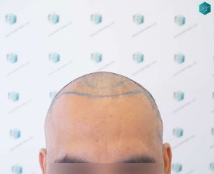 Injerto Capilar Técnica FUE Grafts 5326 (13645 Pelos) 19 20 DISENO DE LA LINEA DEL TRASPLANTE DE PELO