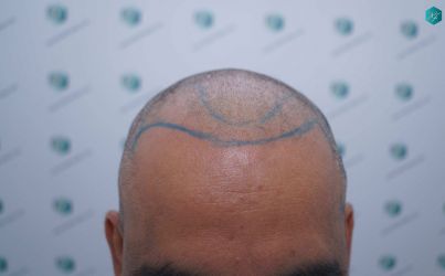 Injerto Capilar Técnica FUE Grafts 5326 (13645 Pelos) 20 21 DISENO DE LA LINEA DEL TRASPLANTE DE PELO