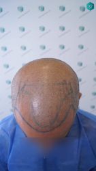 Injerto Capilar Técnica FUE Grafts 5326 (13645 Pelos) 21 22 DISENO DE LA LINEA DEL TRASPLANTE DE PELO