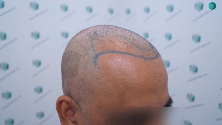 Injerto Capilar Técnica FUE Grafts 5326 (13645 Pelos) 22 23 DISENO DE LA LINEA DEL TRASPLANTE DE PELO