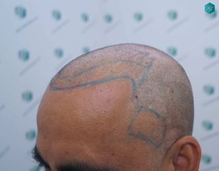 Injerto Capilar Técnica FUE Grafts 5326 (13645 Pelos) 23 24 DISENO DE LA LINEA DEL TRASPLANTE DE PELO